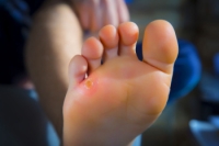 Where Do Foot Corns Develop?