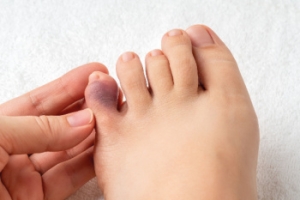 Broken Pinky Toes